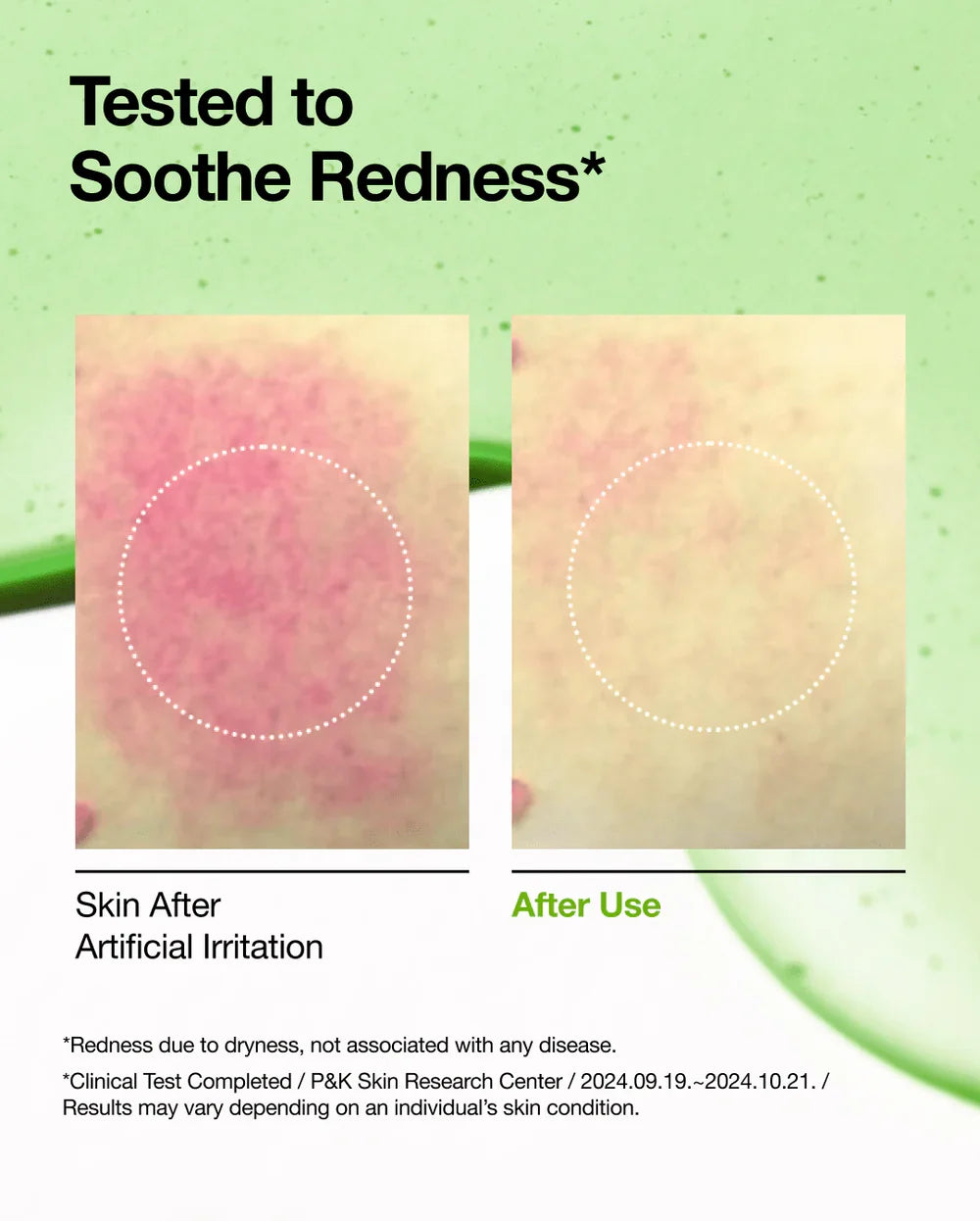 ANUA AZELAIC ACID 10 HYALURON REDNESS SOOTHING SERUM